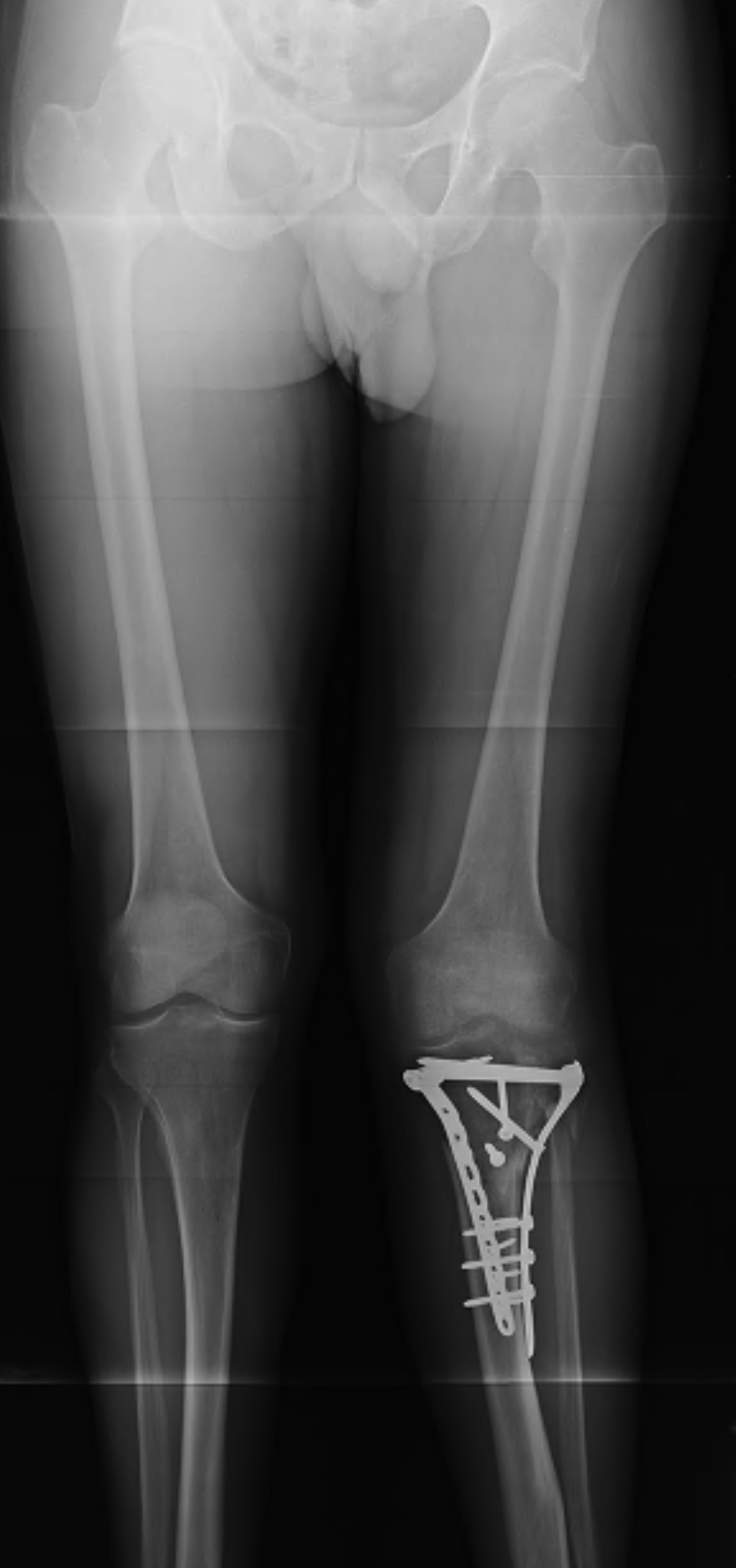 Tibial Plateau Malunion 2